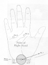 Laser Acupuncture Therapy for Carpal Tunnel Syndrome and Hand Spasticity