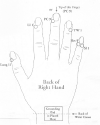 Laser Acupuncture Therapy For Carpal Tunnel Syndrome and Hand Spasticity