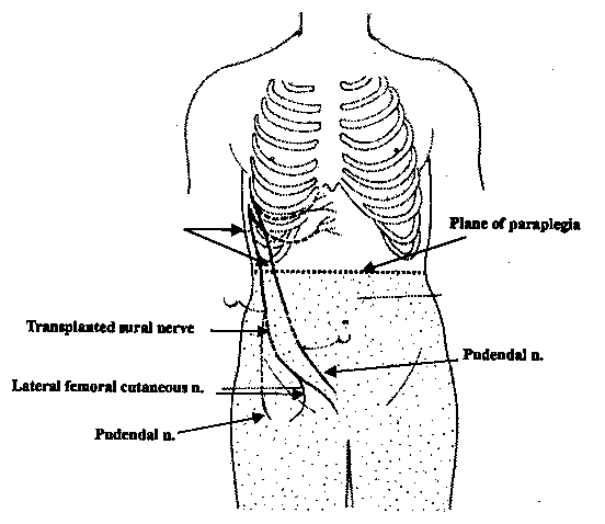 Peripheral Nerve Rerouting Surgery for Spinal Cord Injury